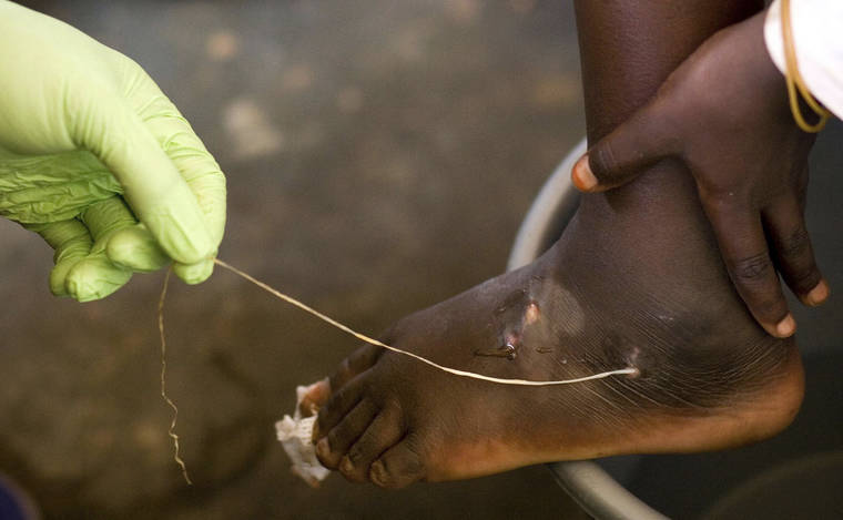ASSOCIATED PRESS
                                A Guinea worm was extracted by a health worker, in March 2007, from a child’s foot at a containment center in Savelugu, Ghana. A new report today, said just over two dozen people in the world are infected with Guinea worm, and community programs are close to eradicating the disease in which a meter-long worm slowly emerges from a blister in a person’s skin.