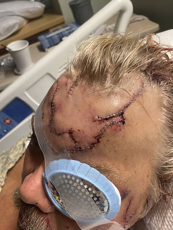 COURTESY ALLEN MINISH VIA AP
                                Lacerations on Allen Minish’s head as he recuperates at a hospital in Anchorage, Alaska, following a mauling by a brown bear.
