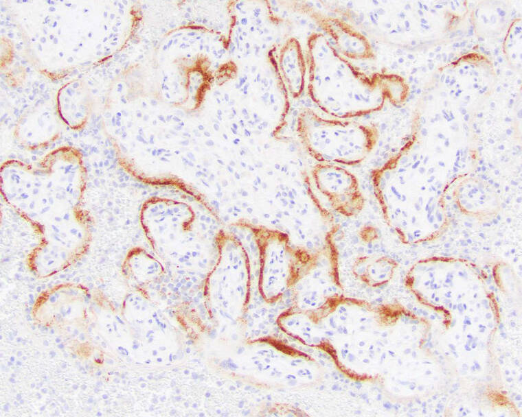 COLLEGE OF AMERICAN PATHOLOGISTS, ARCHIVES OF PATHOLOGY AND LABORATORY MEDICINE VIA ASSOCIATED PRESS
                                This microscope image shows placental cells from a stillbirth with SARS-CoV-2 infection indicated by the darker stains. Research published, Thursday, suggests the coronavirus can invade and destroy the placenta in a deadly process that may be a major cause of stillbirths in infected pregnant women.