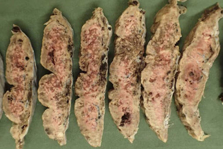 COLLEGE OF AMERICAN PATHOLOGISTS, ARCHIVES OF PATHOLOGY AND LABORATORY MEDICINE VIA ASSOCIATED PRESS
                                This photo shows sections of a placenta affected by SARS-CoV-2 placentitis, with destructive lesions leading to placental insufficiency and stillbirth. Research published, Thursday, suggests the coronavirus can invade and destroy the placenta in a deadly process that may be a major cause of stillbirths in infected pregnant women.