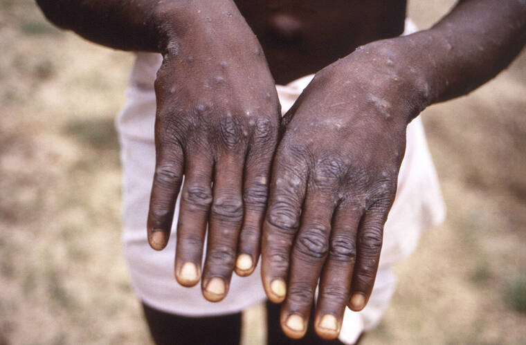CDC VIA ASSOCIATED PRESS
                                This 1997 image provided by the CDC during an investigation into an outbreak of monkeypox, which took place in the Democratic Republic of the Congo (DRC), formerly Zaire, depicts the dorsal surfaces of the hands of a monkeypox case patient, who was displaying the appearance of the characteristic rash during its recuperative stage.