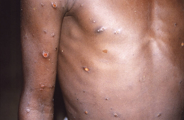 CDC VIA ASSOCIATED PRESS
                                This 1997 image provided by CDC, shows the right arm and torso of a patient, whose skin displayed a number of lesions due to what had been an active case of monkeypox.
