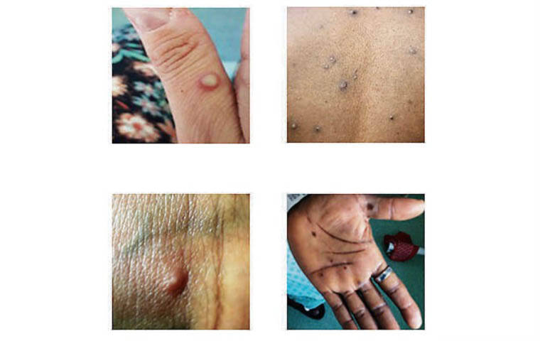 COURTESY CDC
                                Photos from the NHS England High Consequence Infectious Diseases Network show examples of monkeypox rashes.